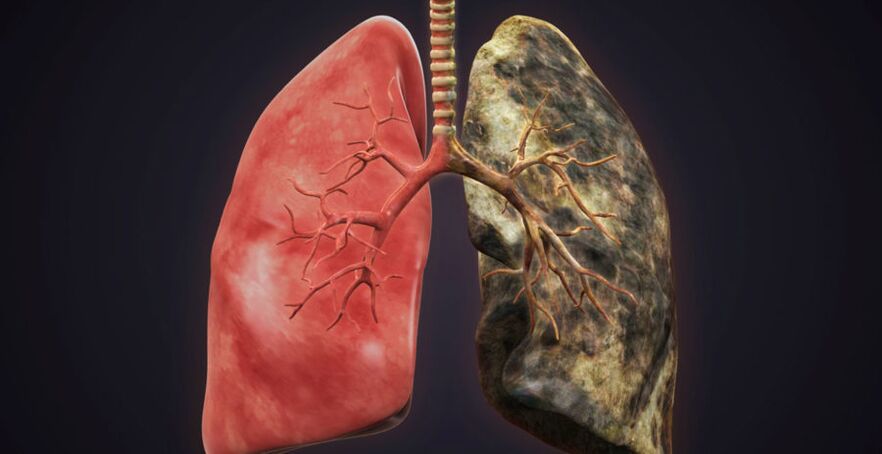 smoker's lung and smoking cessation lung